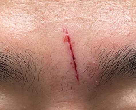 얼굴에 상처가 났을 때, 어떻게 대처해야 할까요? (1)