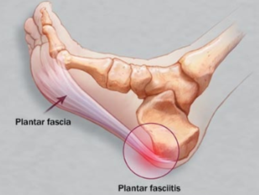 아침에 첫 발을 디딜 때 통증이 있다면, 족저근막염을 의심해보세요.