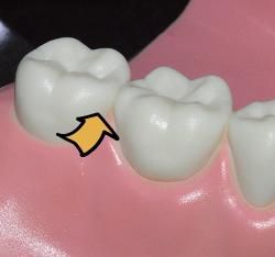 치아 사이에 음식물이 낀다면