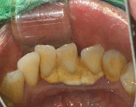 치과 스케일링이란