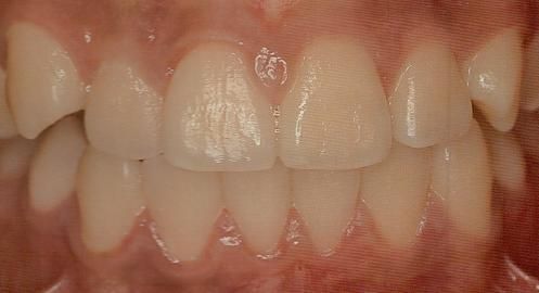 치아색을 밝게 하는 미백이란