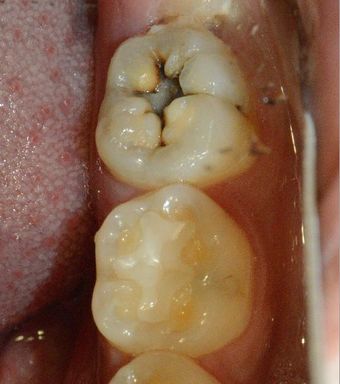충치에 대해서 알아 봅시다