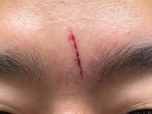 얼굴에 상처가 났을 때, 어떻게 대처해야 할까요? (3)