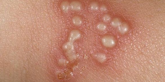 생식기에 물집이 생겼는데… 헤르페스일까요?