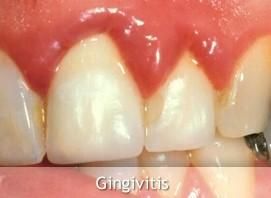 이 3가지 증상이 있다면 잇몸이 망가지고 있는것 입니다.