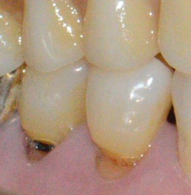 치아가 시린이유 - 마모증