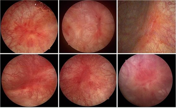 소변을 보면 아픈데, 균이 없다고 합니다.  간질성 방광염일까요?