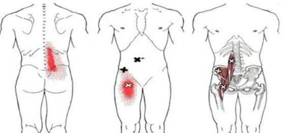 잠잘 때 허리통증이 있다면, 장요근을 확인하세요