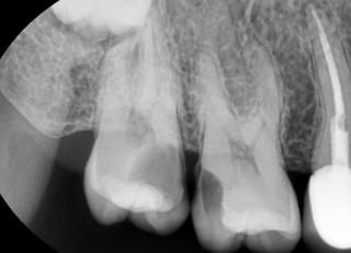 모든 충치는 치료를 해야 할까?