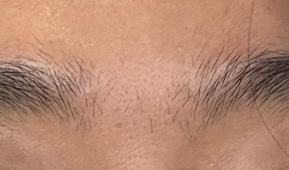 얼굴에 상처가 났을 때, 어떻게 대처해야 할까요? (최종편)