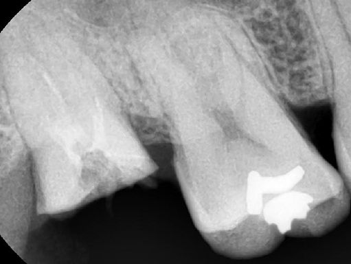 뿌리만 남은 치아를 살리는 법 - 포스트치료