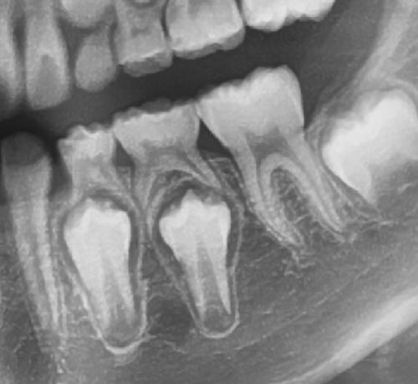 집에서 유치를 발치해도 될까?