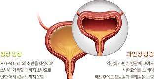 소변이 갑자기 급하고, 자꾸 화장실을 찾으신다면 — 과민성 방광(OAB)에 대해 알아야 할 것들