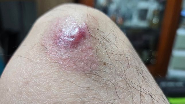 병원가야할까요? 넘어졌는데 물집이 생겼네요의 0번 째 이미지