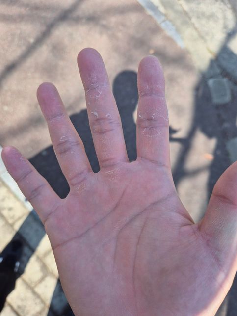 운동을 하고 손을 보니깐 손이 조금씩 벗겨지는데 괜찮나요?의 0번 째 이미지