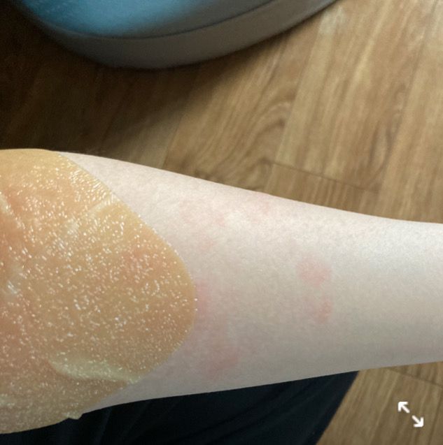 팔의 2도 화상 연고 바르는 법 질문합니다의 2번 째 이미지