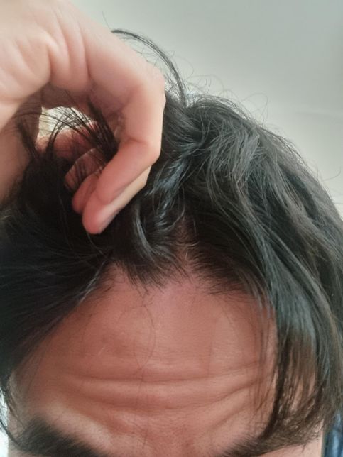 탈모약이랑 탈모 영양제 먹어도 머리가 빠질때의 3번 째 이미지