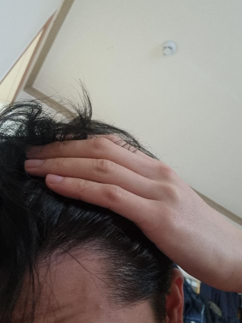 탈모약이랑 탈모 영양제 먹어도 머리가 빠질때의 2번 째 이미지