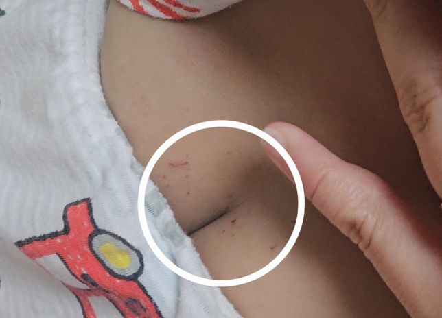 그럼 땀띠랑 긁은 부분이 같은 부분이면 리도맥스 도포후 항생제연고 바르면될까요?의 0번 째 이미지