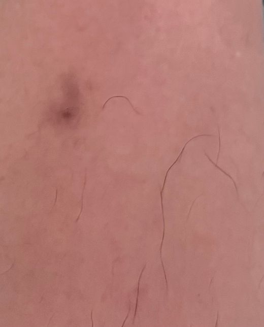 헥시코올스틱스왑액 상처 소독 후 색소침착 관리의 0번 째 이미지