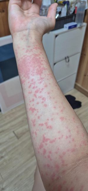 풀독이 너무 간지러운데.여기에 평소 쓰는 조습 용품을 발라도 될까요?의 0번 째 이미지