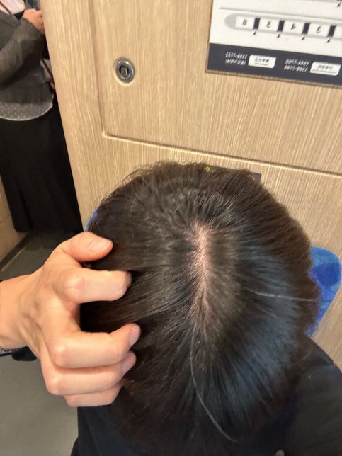 사진찍은거 한번좌주세요 머리 정수리 탈모 사진인데의 0번 째 이미지