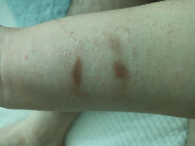 화상흉터가 팔에 4~5개 있는데 흉이 안없어지네요;;의 0번 째 이미지