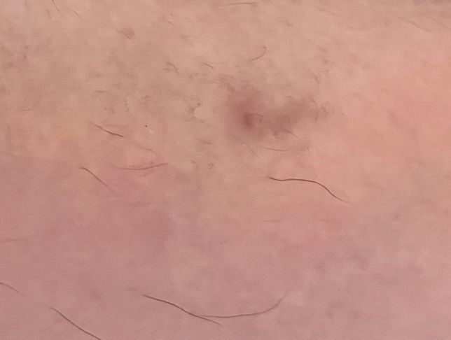 상처난 피부 헥스코올 소독 이후 흉터관리 문의의 0번 째 이미지