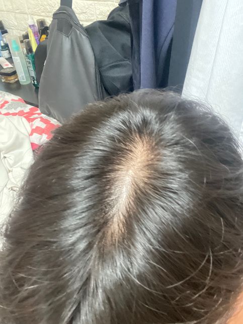 혹시 이거 탈모인가요? 갑자기 걱정되네요의 0번 째 이미지