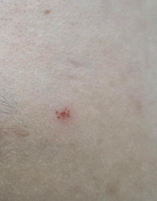 이거 벌레가 문 자국일까요 아님 긁힌상처일까요??의 2번 째 이미지