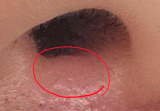 박테로신 연고 콧구멍 입구에 발라도 되나요?(사진)의 0번 째 이미지