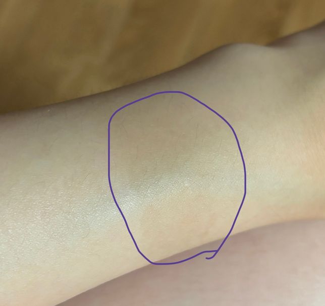 얼굴 리쥬란,co2 레이저 전에 데타손크림 발라도 되나요?의 0번 째 이미지