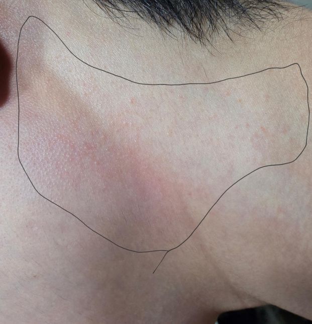 두드러기?에는 뭘 바르는게 좋을까요?의 0번 째 이미지