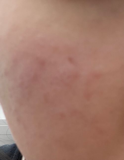 양쪽 볼 피부 트러블 약국 약 질문드립니다의 0번 째 이미지