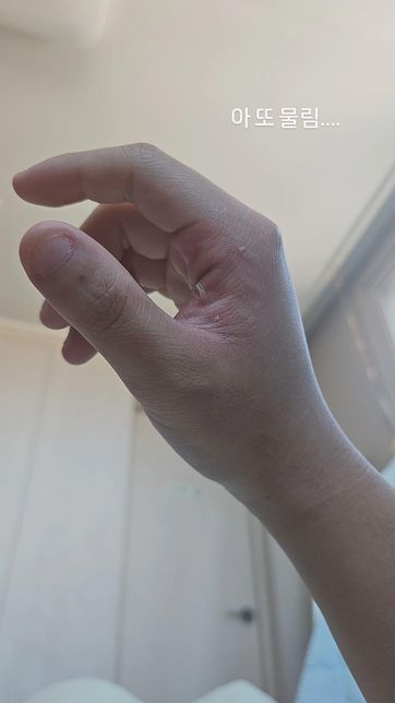 강아이한테 물림 찢어진건가 뭘까??의 0번 째 이미지