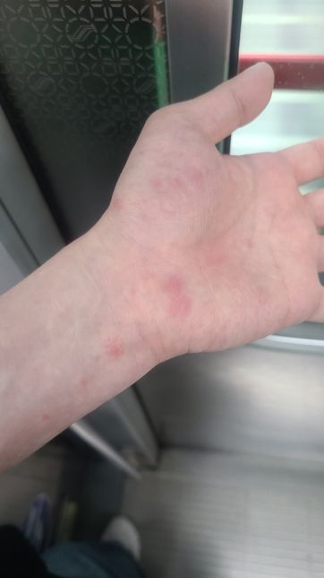 홍삼 스틱을 먹고 두드러기기가 났습니다의 0번 째 이미지