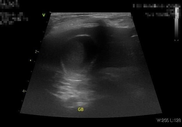 한의학에선 담낭슬러지를 어떻게 없애주나요? 그리고 운동이라던지 물을 많이먹으라던지 그런 요법 같은게 있나요? 한의학에선 어떻게 다른지 좀 알고의 0번 째 이미지
