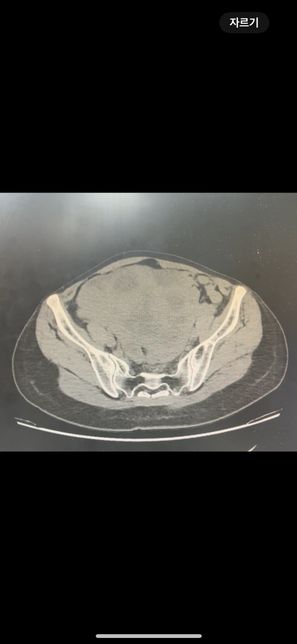 복부 ct 영상 판독부탁드립니다.!의 1번 째 이미지
