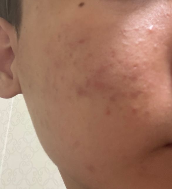 남자 청소년 피부 관리에 대하여 질문함의 1번 째 이미지