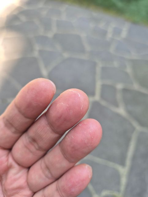 수영장 다니면서 계속 이렇게 손가락 껍데기가 벗겨집니다의 0번 째 이미지