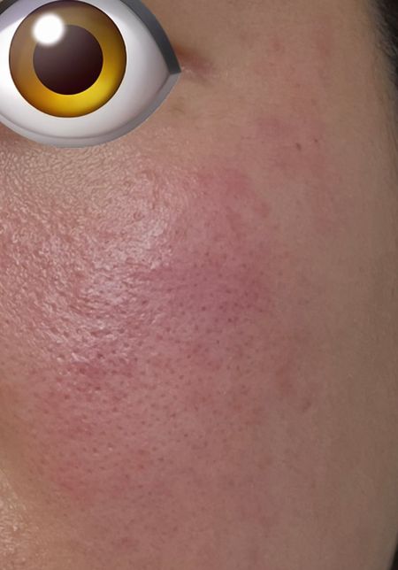 얼굴이 자잘자잘하게 부었는데 약영향일까요?의 0번 째 이미지