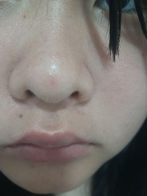 (사진첨부) 저 처진 세로 모공, 블랙헤드, 화이트헤드, 여드름 엄청 많은데... 이거 어떻게 해야하나요?의 0번 째 이미지