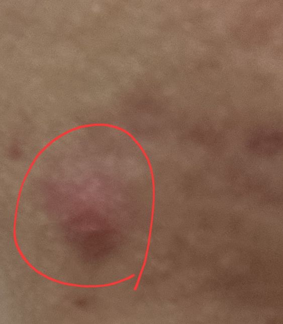 여드름이 계속 그대로 있으면 어떡해야 하나요의 1번 째 이미지