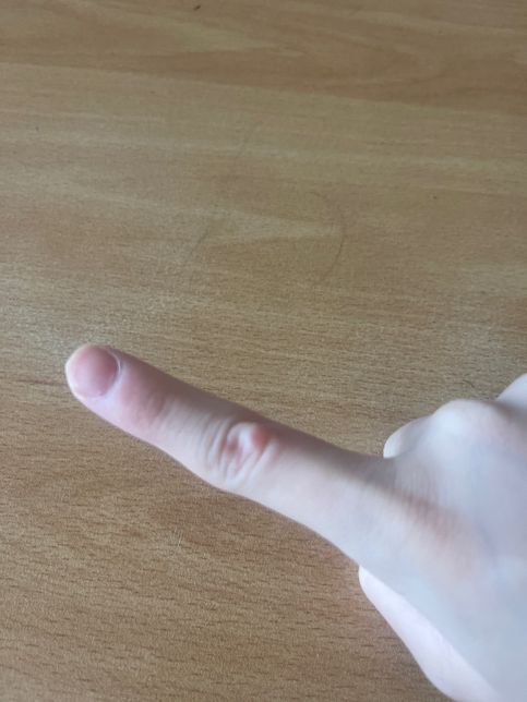 손가락에 모기인지 뭐가 물렸는데 간지러운데 이게 뭔가요?의 0번 째 이미지