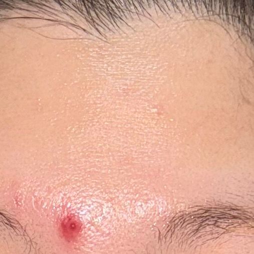 여드름이 터졌는데 어떤약을 발라야할까요?의 0번 째 이미지