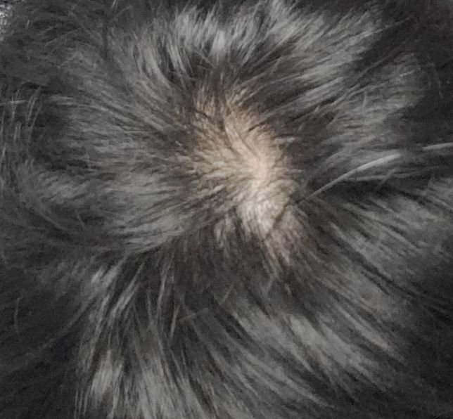 이정도면 탈모약이나 탈모관리 받아야 되나요??의 0번 째 이미지