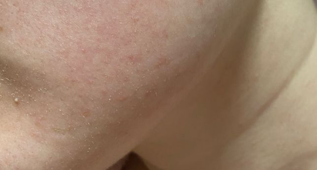 이거 왜 그러는거일까요?ㅠㅠ 원인이 뭘까요? 피지인지 피부장벽이 무너져서 그런건지 모공이 막혀서 그런건지 모르겠어요의 0번 째 이미지
