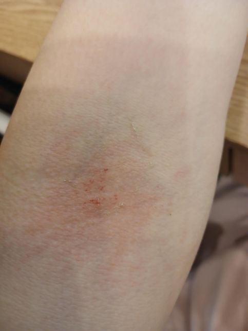 긁으니까 피가나요~ㅠㅠ왜그런걸까요?의 0번 째 이미지