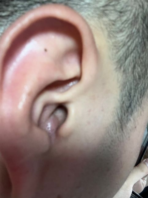 귀안에 종기가낫는데,, 한 일주일만 지켜보고 안되면 병원가려하는데요. 약국에서 사먹을수있는 약이 어떤게있을까요??의 0번 째 이미지