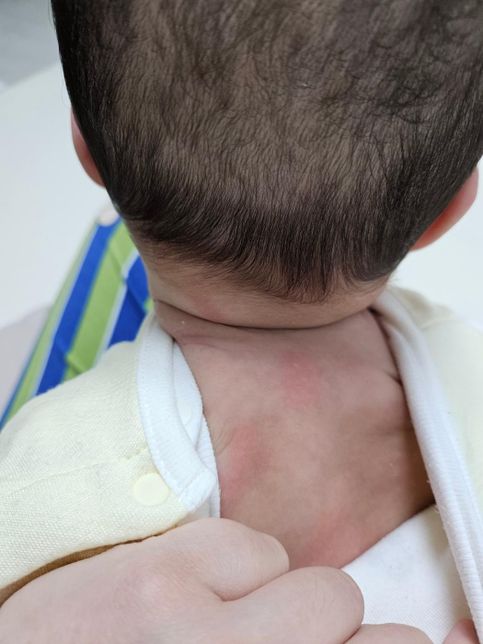 이유식 새로운 재료 추가할때마다 3일차에 알러지가 나타나요의 1번 째 이미지